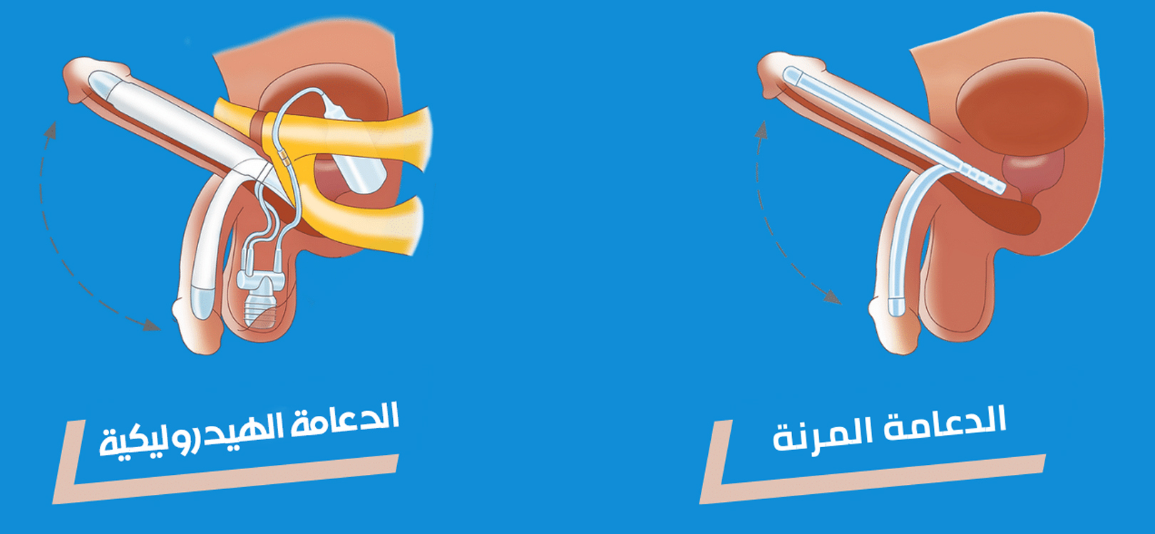 زراعة الدعامة الذكرية
