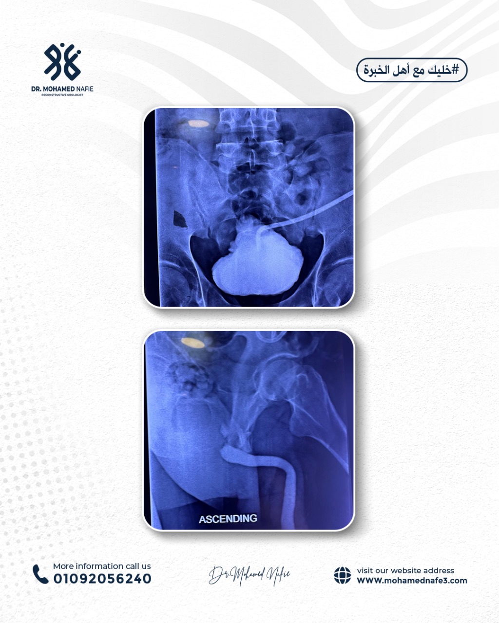 خلال يومين فقط: خمس حالات معقدة لقطع وتهتك مجرى البول