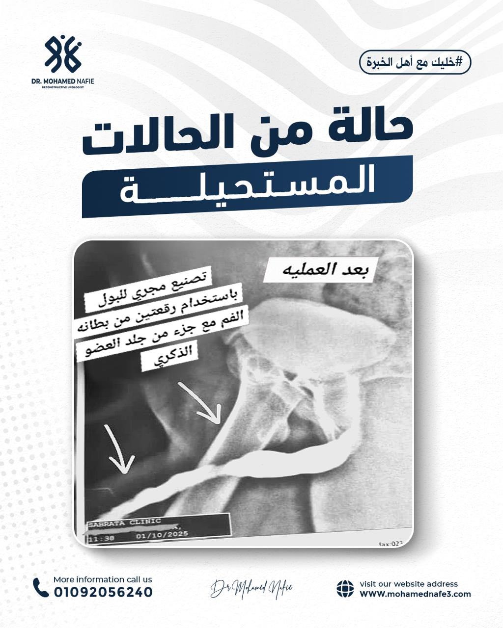  شاب من ليبيا وُلد بدون مجرى بول نهائيًا – قصة إنجاز طبي فريد