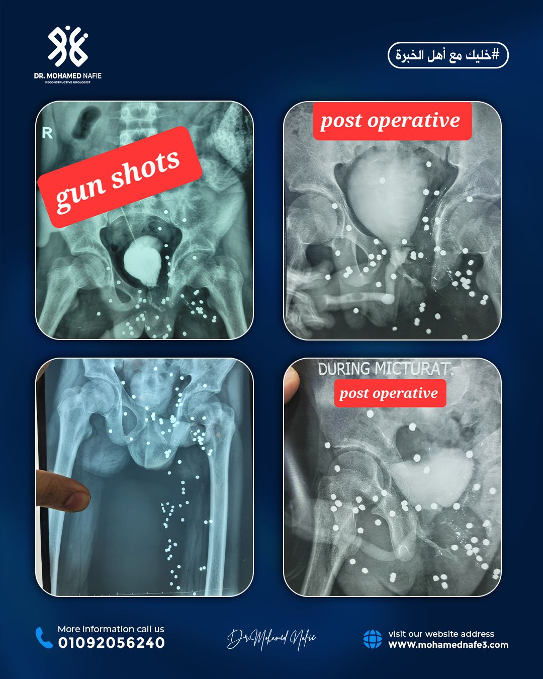 قصة طبية من المغرب… حين يتحول المستحيل إلى واقع