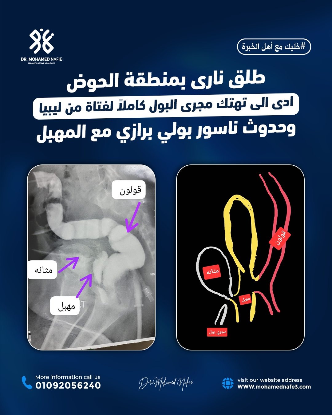 عندما نقول إننا المركز الأكبر لجراحات مجرى البول والحالات المعقّدة…