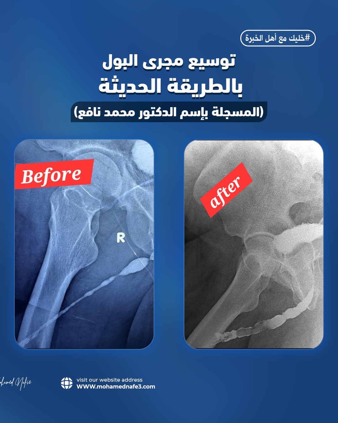 طريقة د. نافع الحديثة لتوسيع مجرى البول