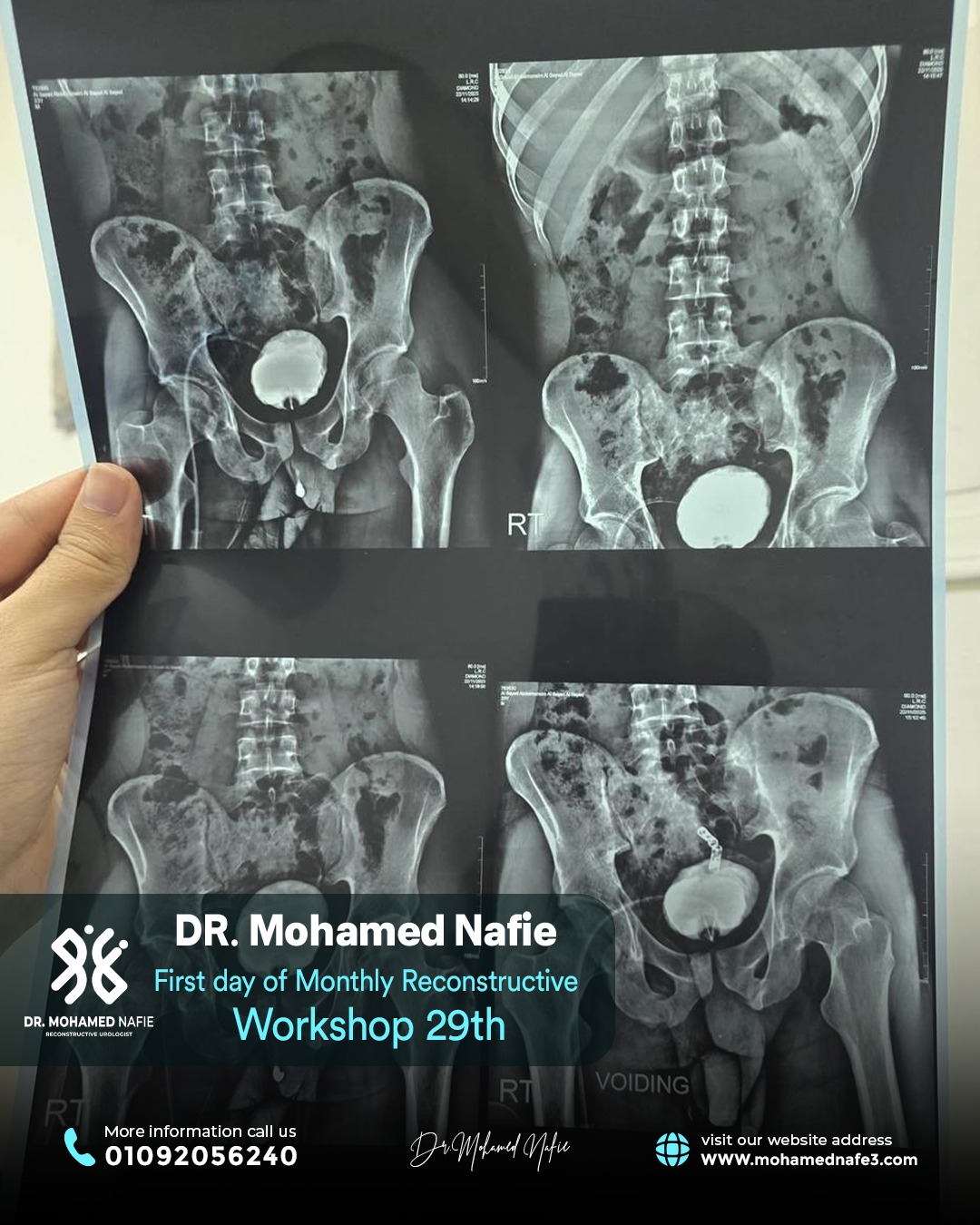 الورشة رقم 29… محطة جديدة في مسيرة التميز الطبي لجراحات مجرى البول