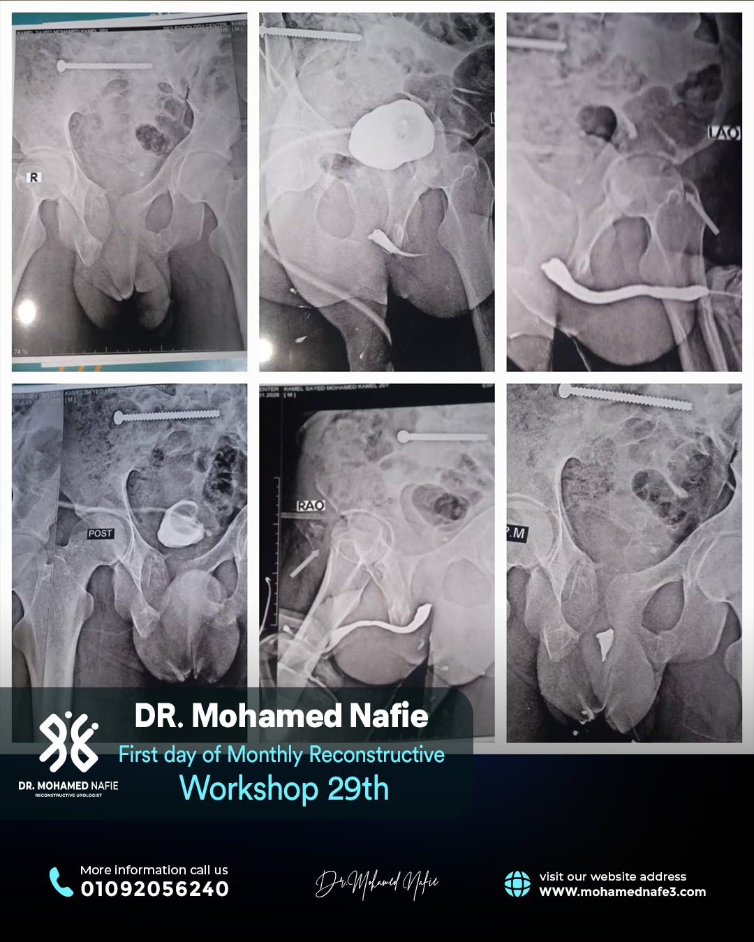 الورشة رقم 29… محطة جديدة في مسيرة التميز الطبي لجراحات مجرى البول