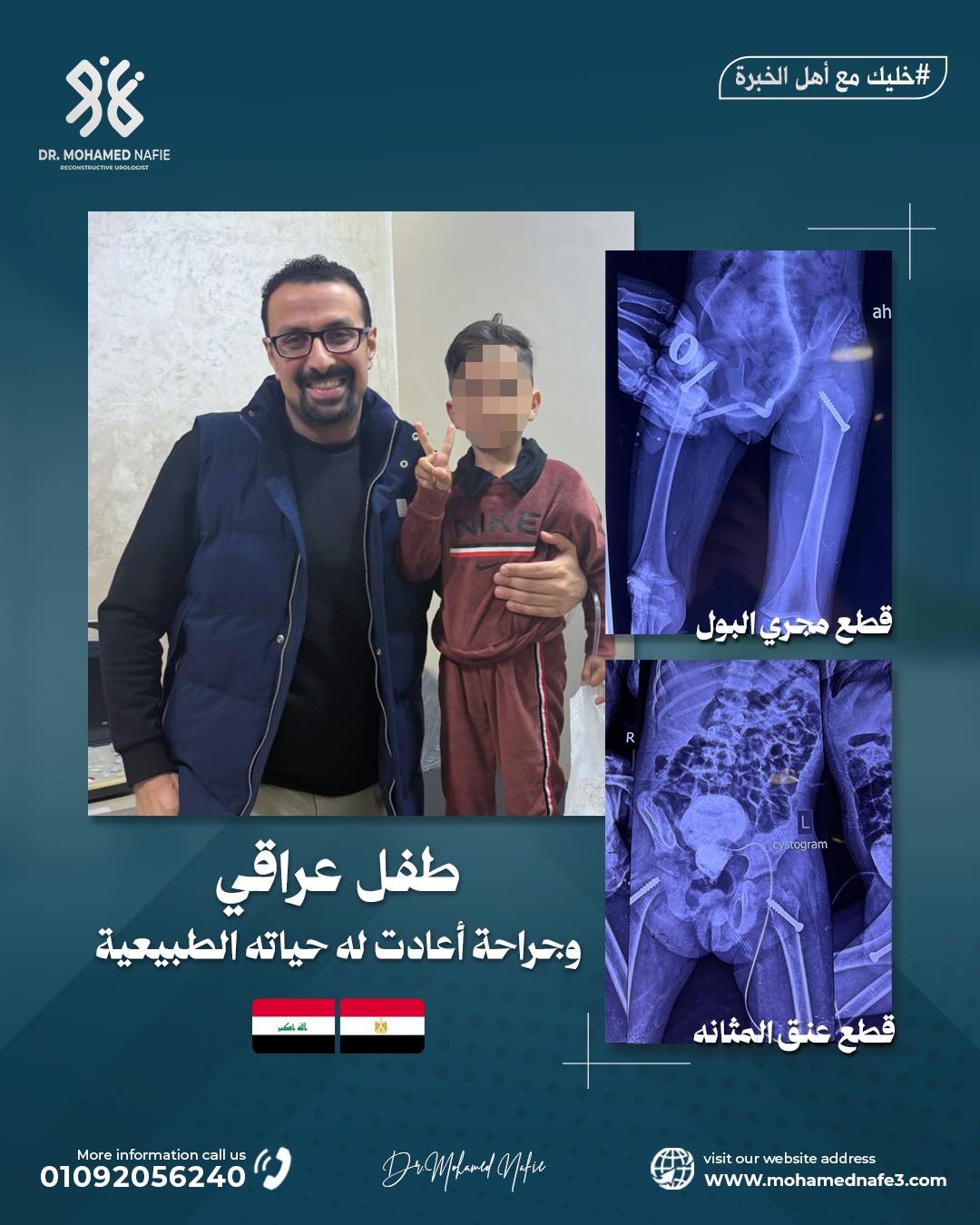  استقبال حالة نادرة لطفل من العراق: جراحة معقدة لإصلاح قطع مزدوج بمجرى البول وعنق المثانة