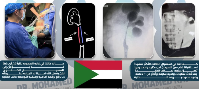  إنقاذ حالة معقدة لتضيق حالب الكُلى بتقنية متقدمة دون اللجوء للغسيل الكلوي