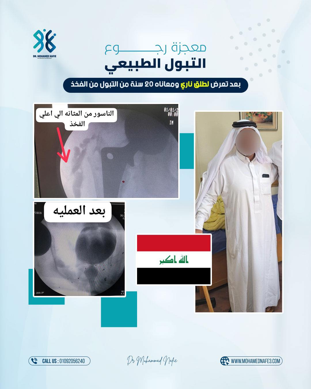  حالة نادرة بعد 20 سنة معاناة… إعادة تكوين مجرى البول بالكامل