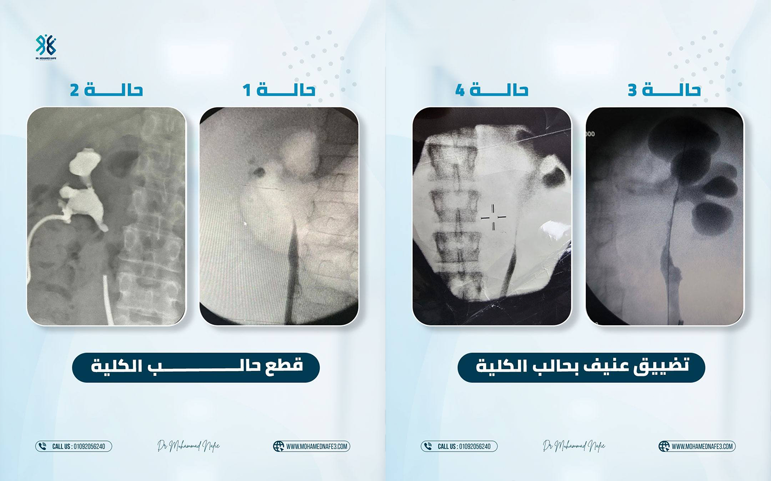  خلال 10 أيام… إنجاز متقدم في جراحات الحالب المعقدة