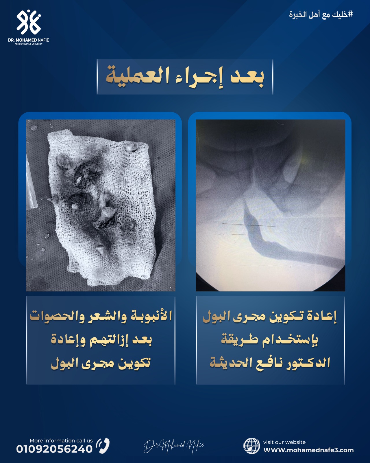 حالة مستحيلة لمريض من ليبيا.. نجاح جديد في إعادة تكوين مجرى البول بعد 20 عامًا من المعاناة