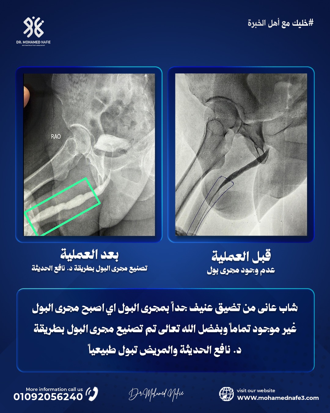 طفرة في جراحات مجرى البول وإعادة بناء مجرى البول بالكامل