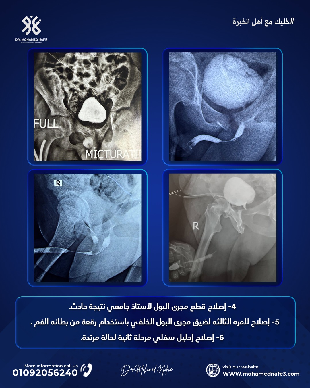 ملحمة طبية وإنجاز استثنائي داخل أكبر وحدة متخصصة في جراحات مجرى البول المعقدة