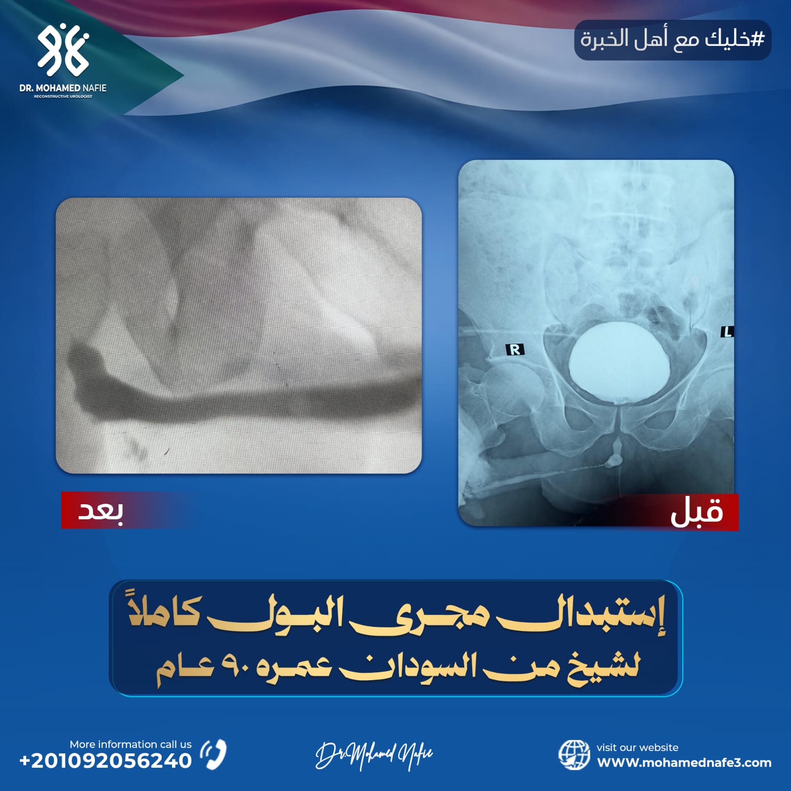 في عمر الـ90 عامًا… لا يزال الأمل ممكنًا: استبدال كامل لمجرى البول