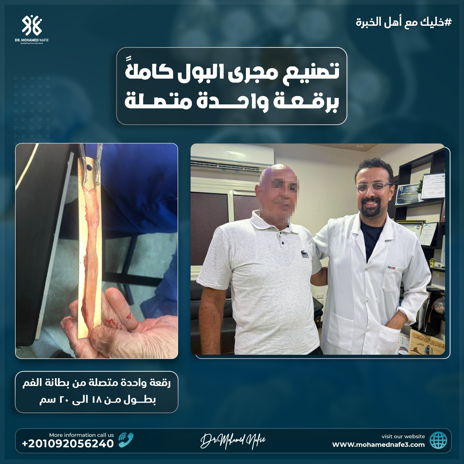  إعادة بناء مجرى البول بالكامل برقعة واحدة من بطانة الفم