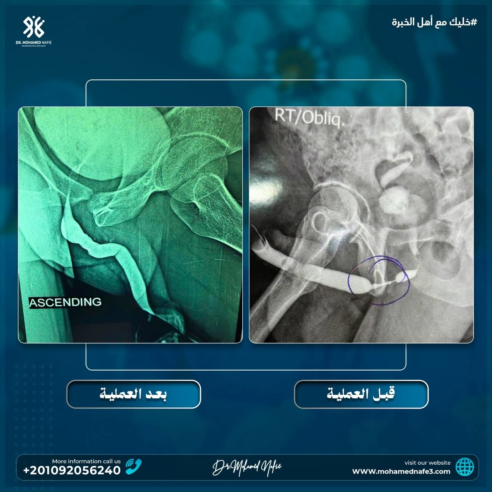 علاج تضيق مجرى البول بعد عمليات سابقة غير موفقة: حالة معقدة لمريض من غزة