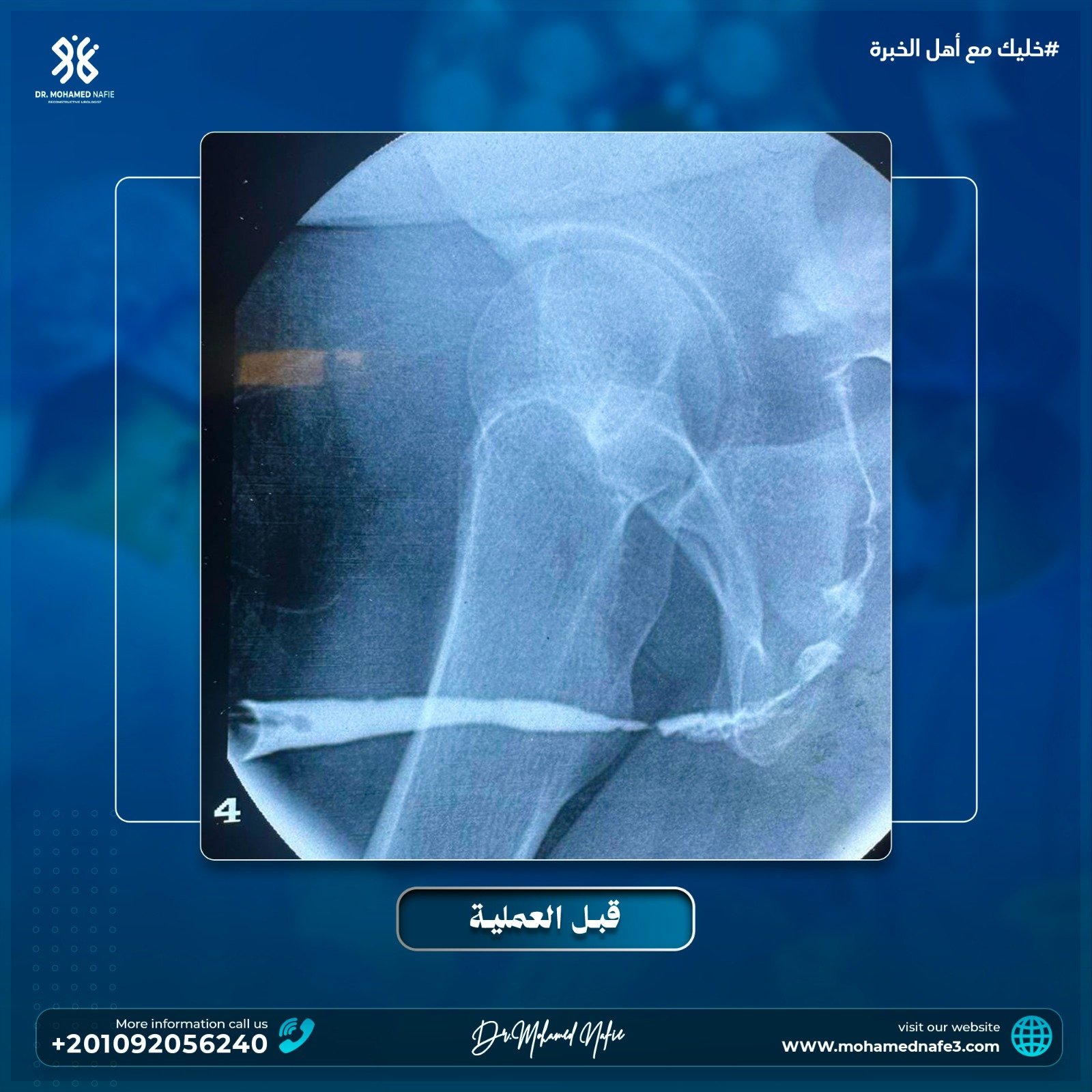 حالة معقدة لمريض كان يُعاني من تضيق وتليف مجرى البول