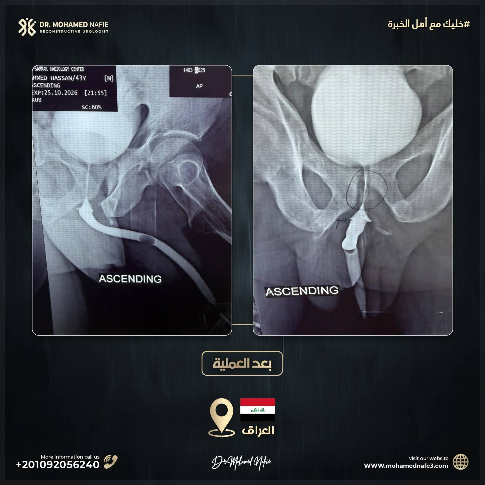 مريض من العراق تعرض لحادث أدى إلى قطع في مجرى البول قريب من صمام التحكم وأعصاب الانتصاب